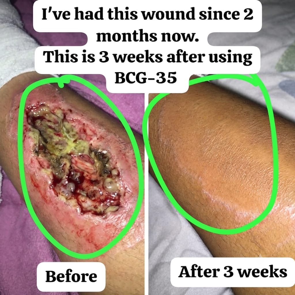 A 2 month wound healed in 3 weeks after using BCG-35
